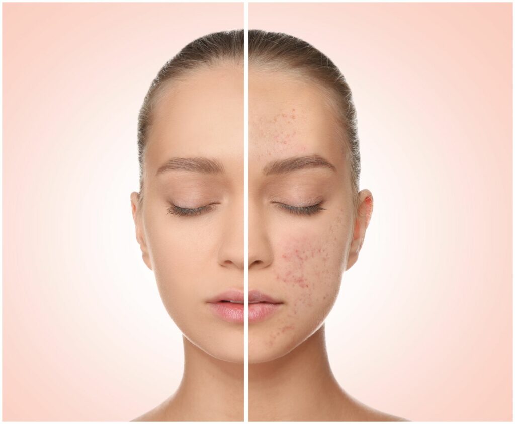 Acne Treatment & Hydration