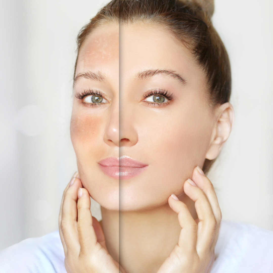 Buy Reborn Cream For Sensitive Area Brightening &amp; Dark Spot Reduction By Wisdom Pharma