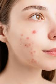 Acne Plus Bar in Pakistan – Medicated Soap with Benzoyl Peroxide &amp; Salicylic Acid for Clear, Pimple-Free Skin